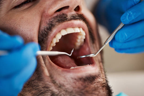 Best Emergency Wisdom Teeth Removal in Parkland, WA